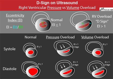 Right Heart Strain from Pressure vs Volume Overload 